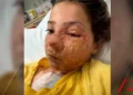 Menina de 10 anos sofre queimaduras no rosto após fazer desafio do TikTok