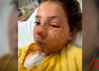 Menina de 10 anos sofre queimaduras no rosto após fazer desafio do TikTok