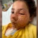 Menina de 10 anos sofre queimaduras no rosto após fazer desafio do TikTok