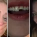Jovem quebra dente na balada no PR, cola na madrugada e volta para a festa