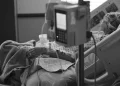Mulher morre após ficar com intestino perfurado em colonoscopia em SP
