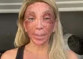 'Não consigo nem rir', diz Maya Massafera mostra rosto inchado após peeling e ironiza reação: 'Não consigo nem rir'
