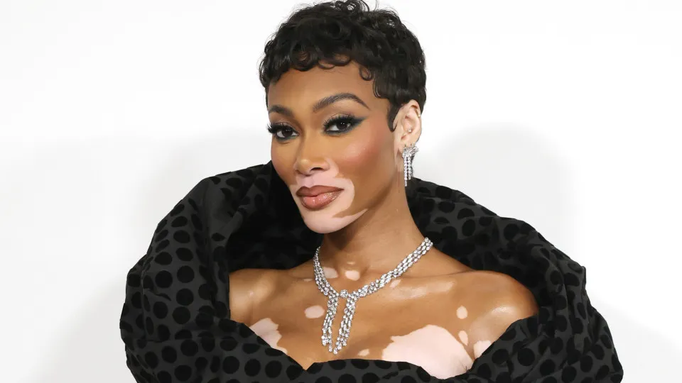 Famosos que sofrem de vitiligo: