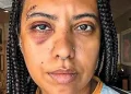 Influenciadora leva seis pontos após agressão em roda de samba no Rio