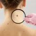 Moderna e Merck anunciam sucesso de vacina experimental com mRNA contra recidiva do melanoma